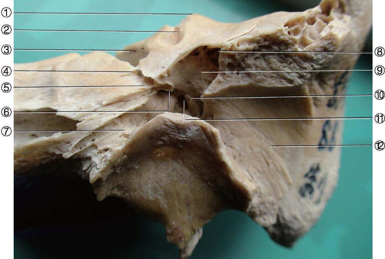 經(jīng)鼓室、面神經(jīng)管膝及面神經(jīng)管骨迷路段至內(nèi)耳道